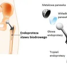 Ile kosztuje endoproteza stawu biodrowego w Niemczech? Ceny zaskakują